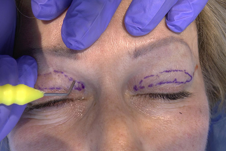 non-ablative blepharoplasty by means of mixed peeling 0.5